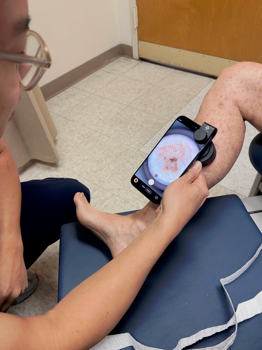 Dermatoscope being used with smartphone attachment during skin exam 