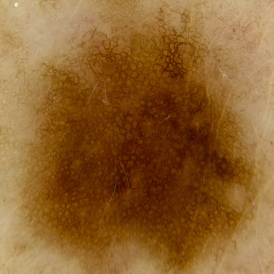 Nevus seen through SkinLens dermatoscope